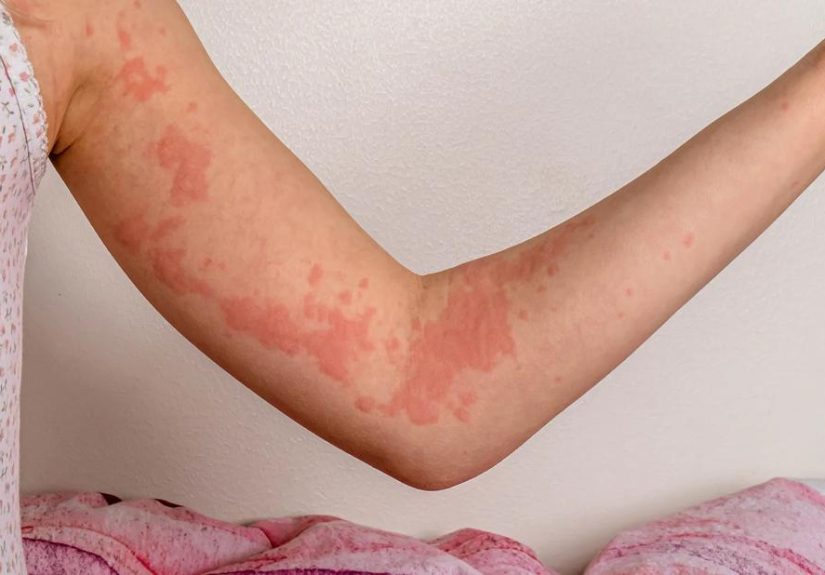 Chronic Hives and Diet: Is There a Connection?