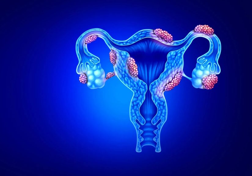 Endometriosis and Blocked Fallopian Tubes: Causes, Treatments