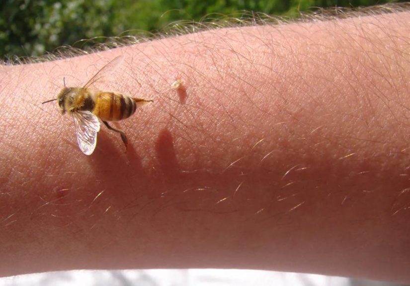 How To Remove a Bee Stinger
