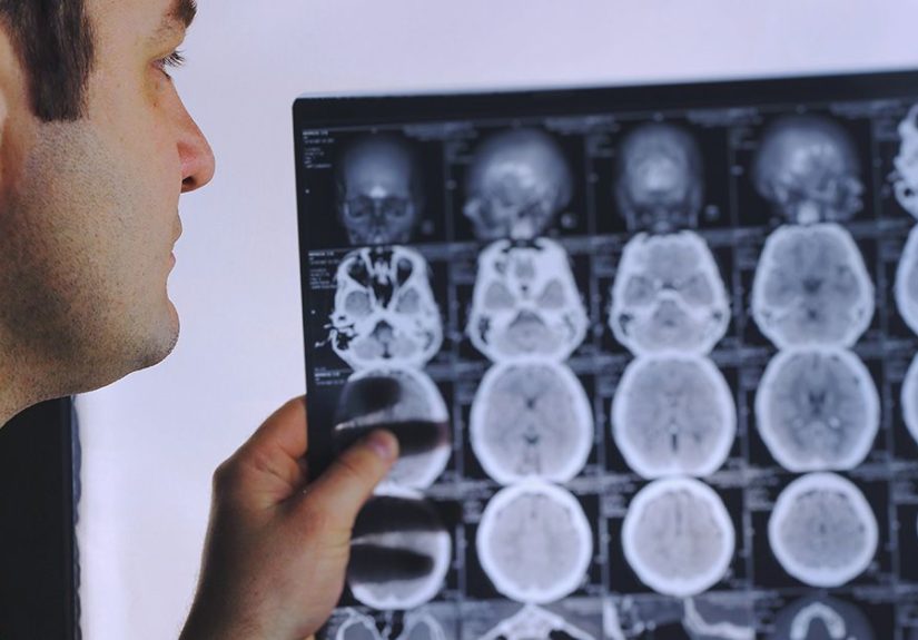 Long-Term Memory Loss: Causes, Symptoms, Treatment, and More