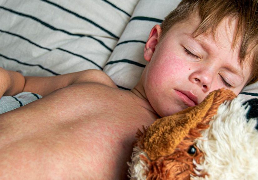 Measles: Early Signs, Prevention Tips, and How to Manage