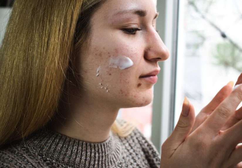 Rosacea vs. Acne: Differences Explained