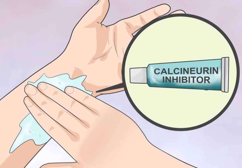 3 Ways to Ease the Symptoms of Spongiotic Dermatitis