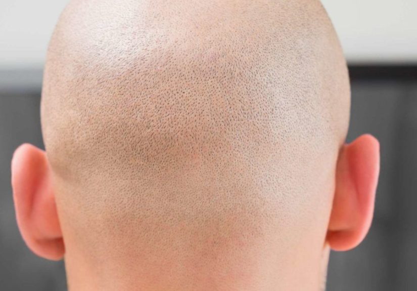Alopecia totalis: Symptoms, treatments, and types