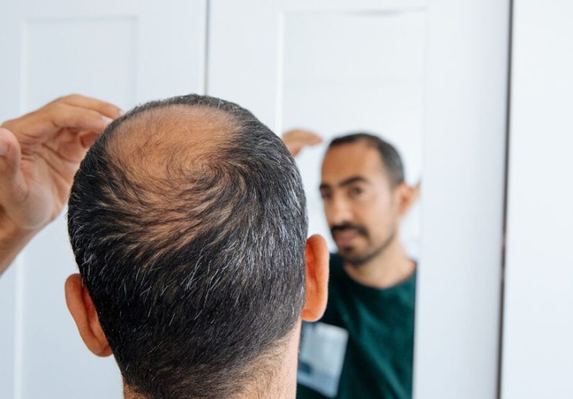 Auvelity: Can This Drug Cause Hair Loss?
