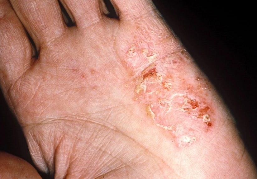 Eczema: Types, Symptoms, Causes, Diagnosis, and Treatment