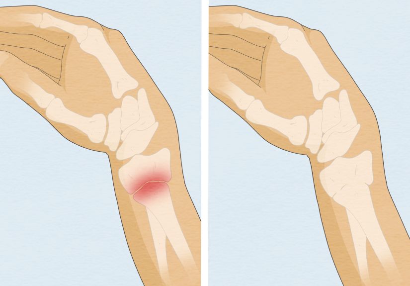 How to Cope With a Broken Wrist