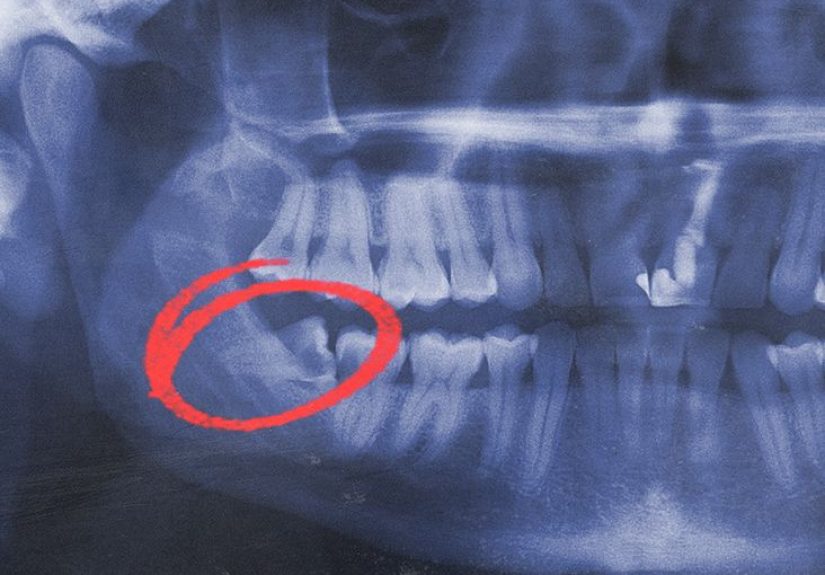Impacted wisdom teeth: Symptoms and removal