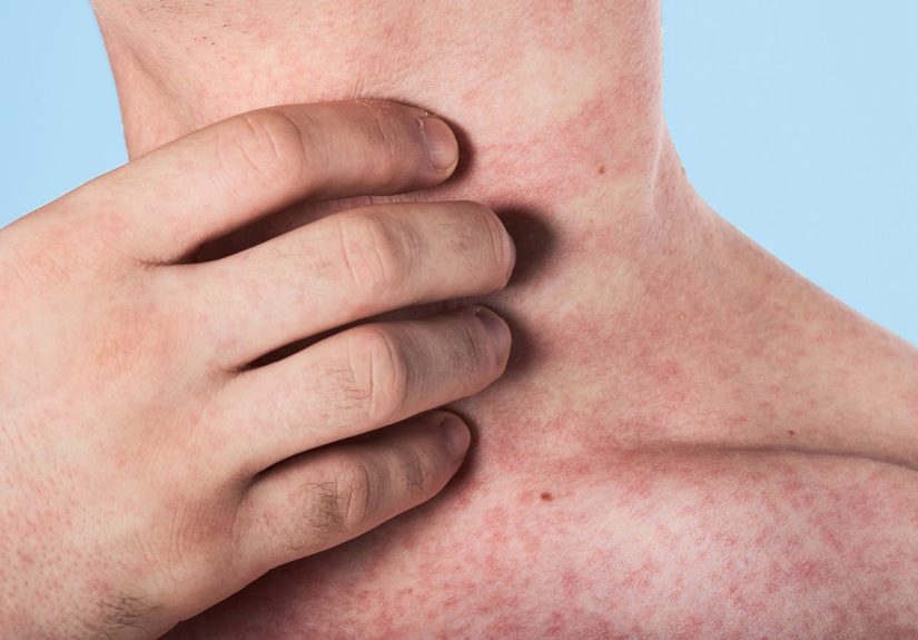 Measles Cases Are Rising Across the U.S., Led by Florida Outbreak