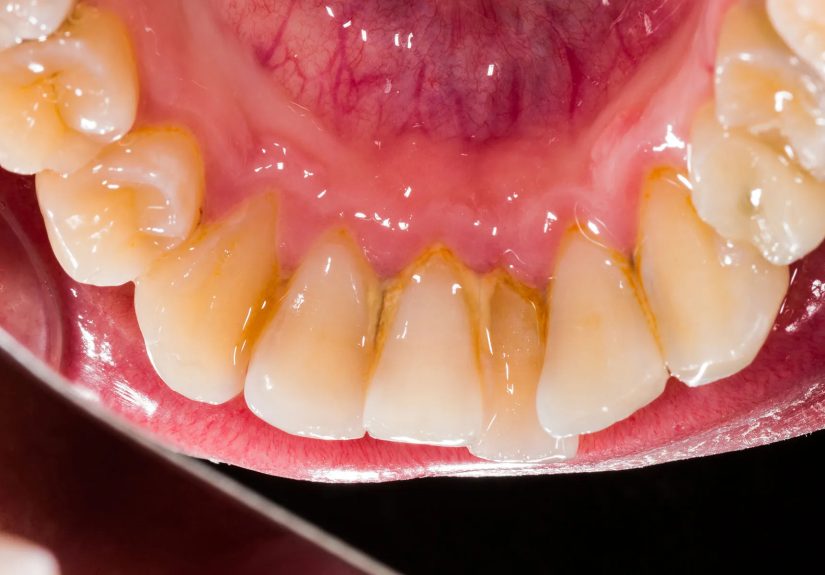 Tooth Plaque Causes, Prevention, and Treatments