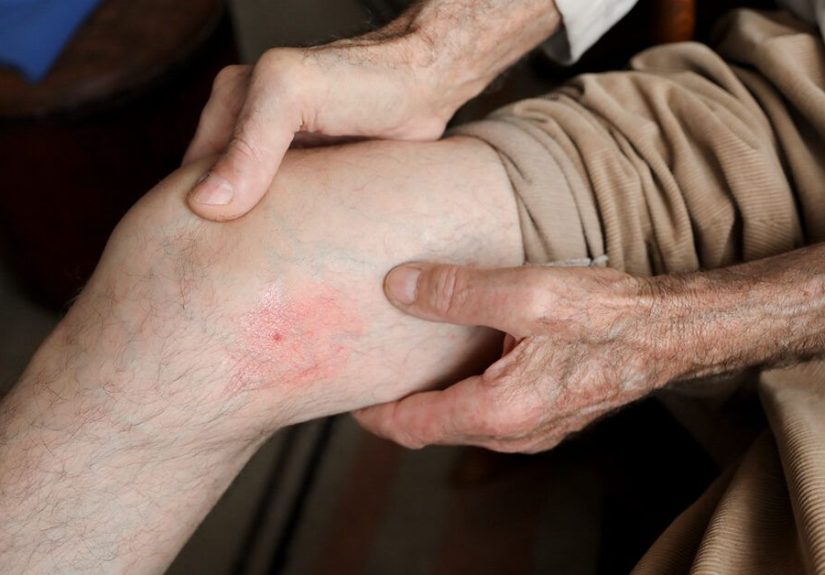 What Does a Blood Clot Feel Like?