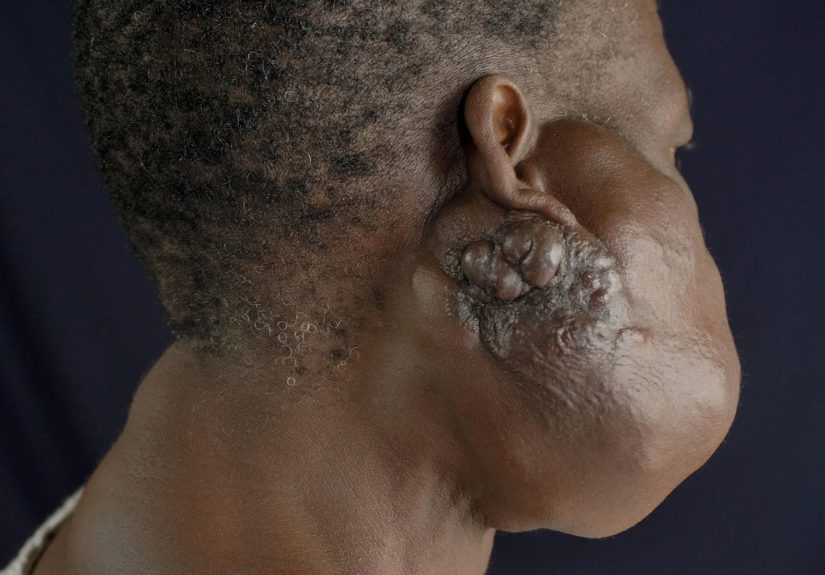 What Is Mucoepidermoid Carcinoma?