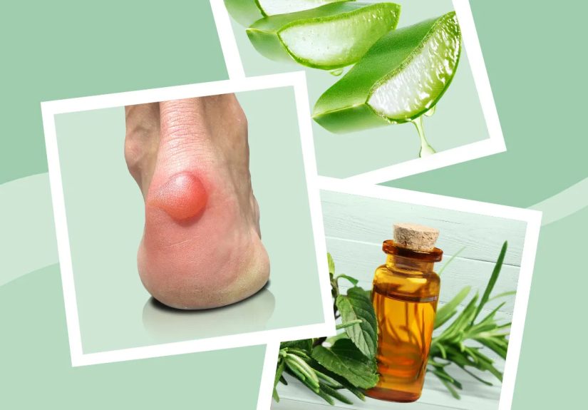 6 Natural Remedies for Blisters