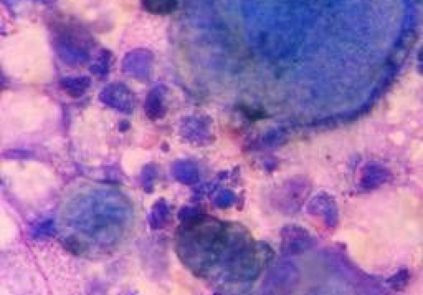 Cytomegalovirus: Symptoms, Treatments, and Types