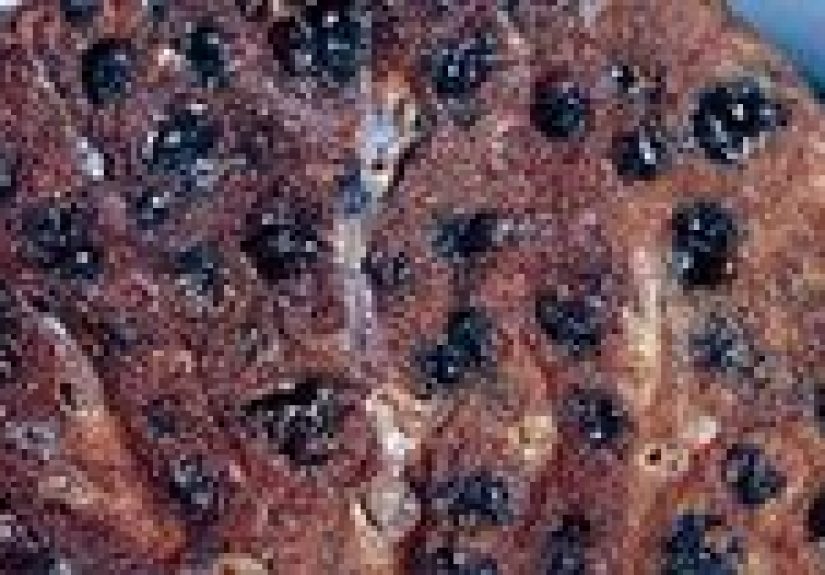 Emphysema: What Is It, Symptoms, Causes, and More