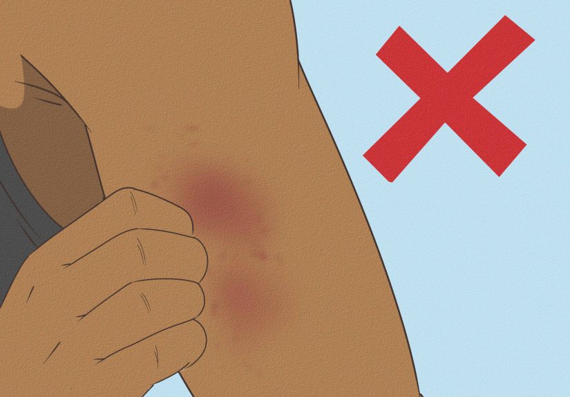 How to Wash Icy Hot off Fast: Stop Burning & Irritation
