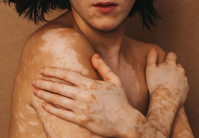 I’m Done with Hiding My Vitiligo