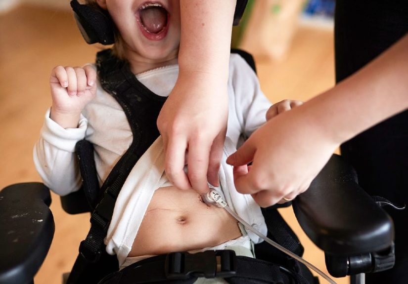 Intestinal Pseudo-Obstruction: Symptoms, Diagnosis, Treatment