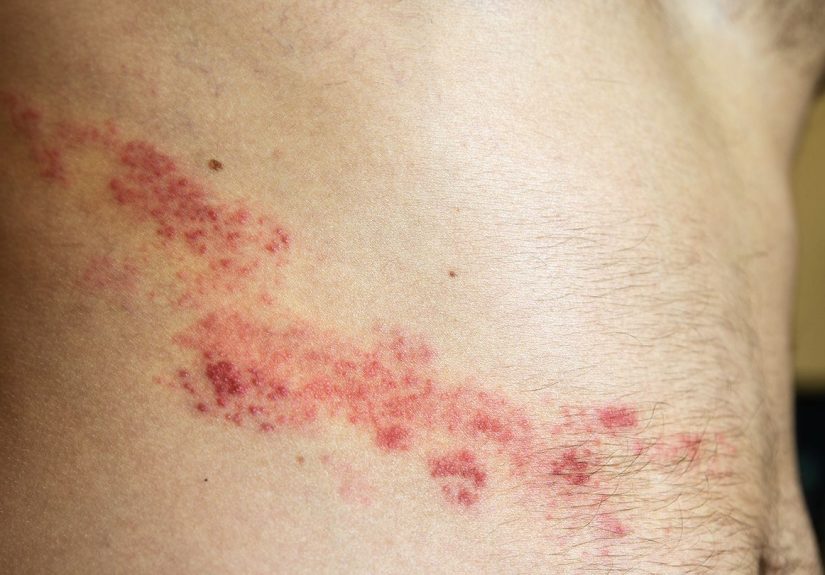 Is It Shingles or Something Else?