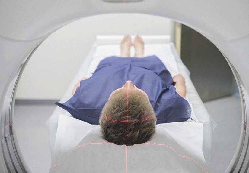 Neurosarcoidosis: Symptoms, Life Expectancy, and Treatment