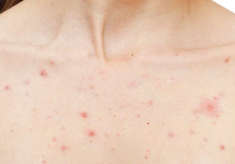 Pimples on breasts: Causes and how to get rid of them