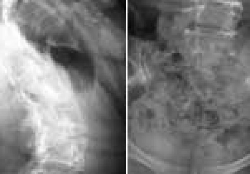 Spinal Cord Injury: Signs, Causes, and Prevention