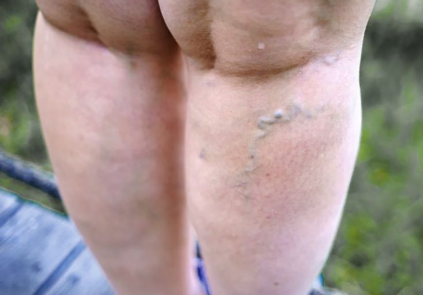 Thrombophlebitis: Symptoms, causes, and treatment