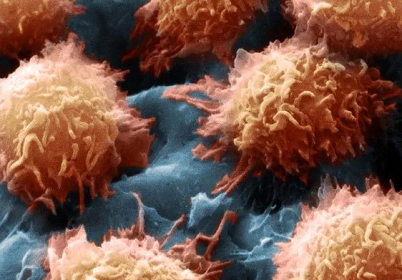 What Is Hairy Cell Leukemia? Treatment, Symptoms, and Causes