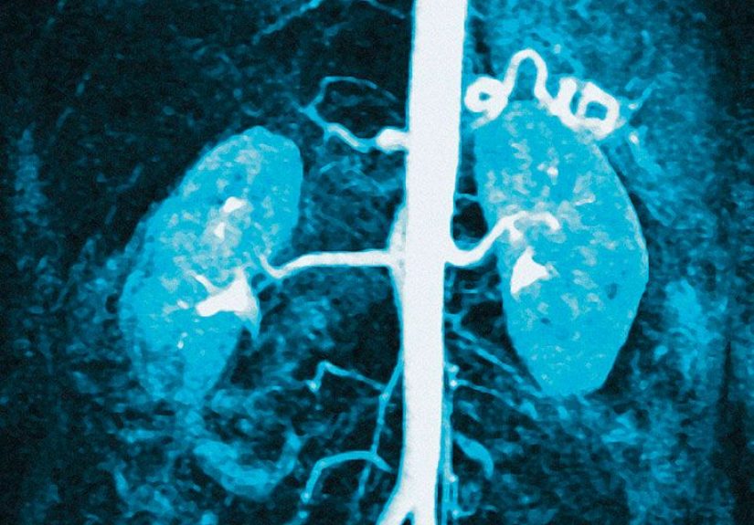 What to know about diabetic nephropathy hyperkalemia