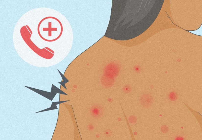 4 Ways to Get Rid of Bug Bites