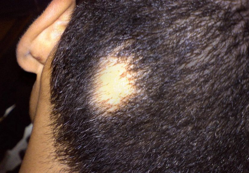 Alopecia Areata & Hair Loss: Causes, Treatments, and Tips to Cope