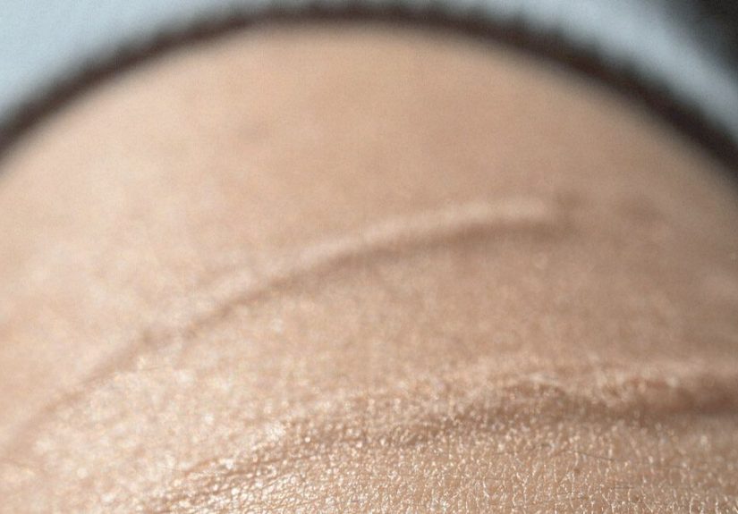 Cómo acabar con las cicatrices viejas: 10 remedios caseros