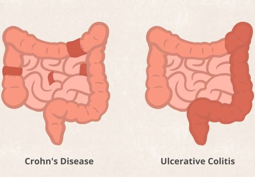 Crohn’s Disease Versus Ulcerative Colitis: What’s the Difference?
