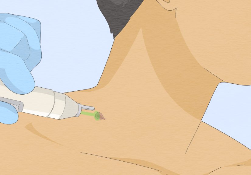 How to Safely Remove a Skin Tag from Your Neck At Home
