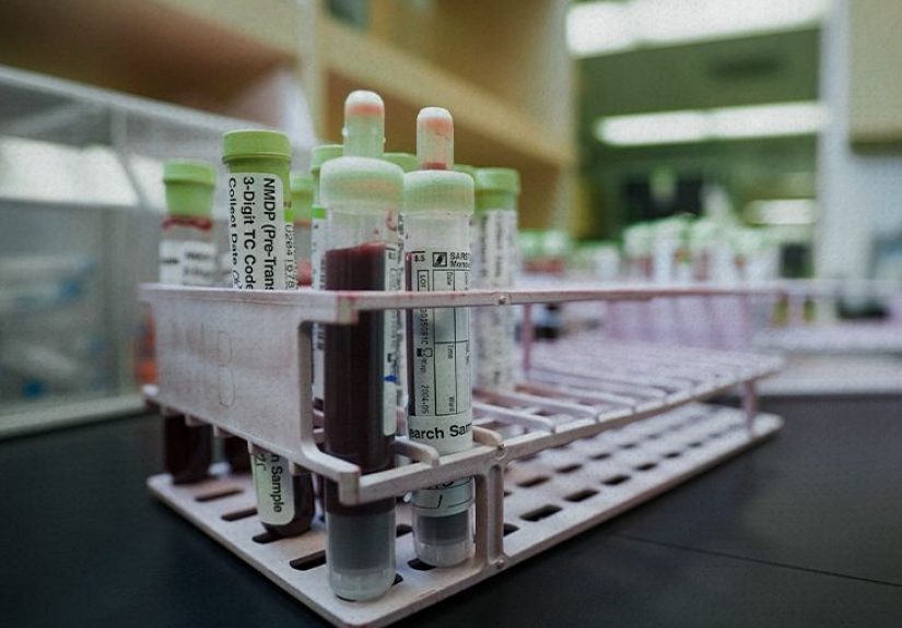 Intraepithelial Lymphocytosis: Causes, Treatment, FAQs, and More