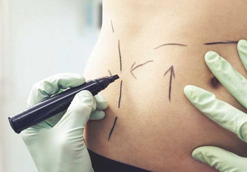 Is Liposuction Safe? What to Expect, Risks, and More