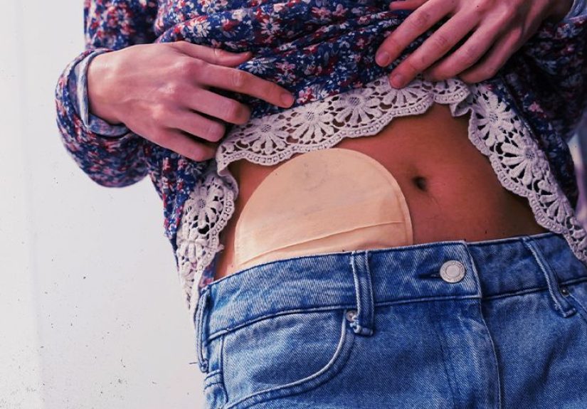 Racial disparities in colorectal cancer: Explanations and how to help