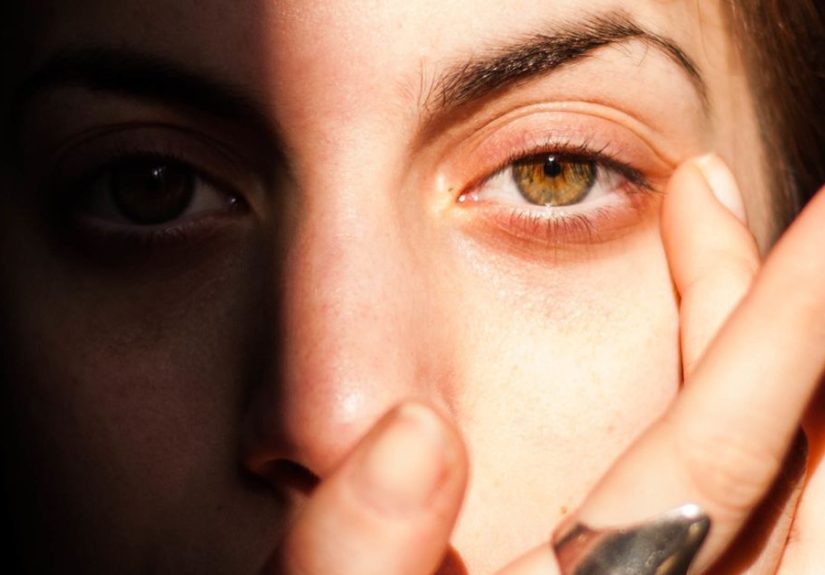 Sunburned Eyes: Causes, Symptoms, and Treatment