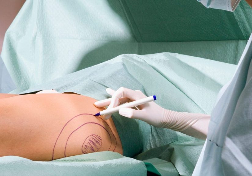 Tumescent Liposuction Benefits, Precautions, Pictures, and Costs