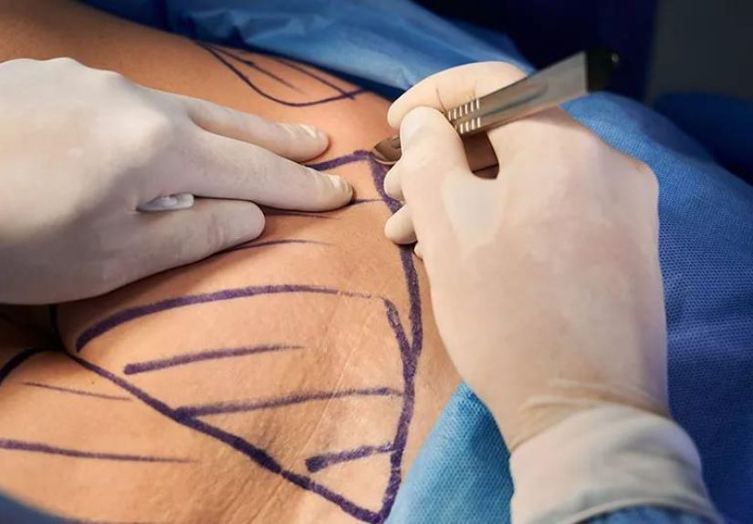 5 Ways To Fight Excess Skin After Bariatric Surgery
