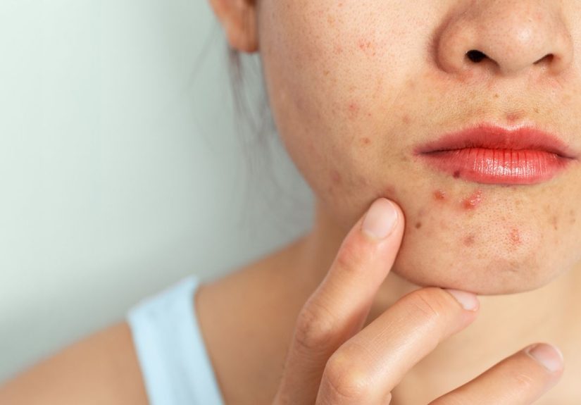Acne Products Recalled for Benzene Contamination