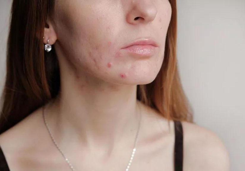 Are Thyroid Issues Causing Your Acne?