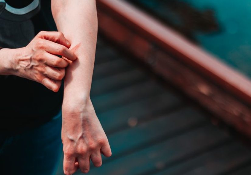 Causes of Nausea in People with Eczema