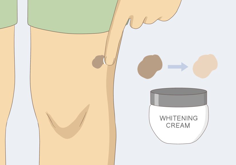 How to Remove Moles Quickly Surgically or at Home