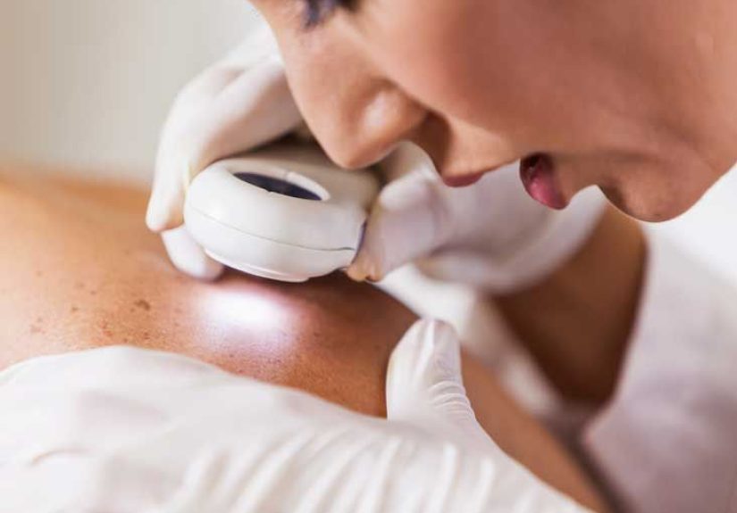 Melanoma Pictures: Skin Changes and What to Look For