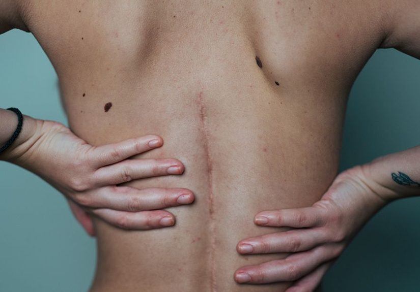 Types of Scoliosis, Their Causes, Diagnosis, and Treatments