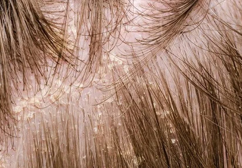 What Is Scalp Eczema? Symptoms, Causes, Treatment, and More